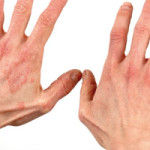 Dermatitis kao profesionalno oboljenje frizera